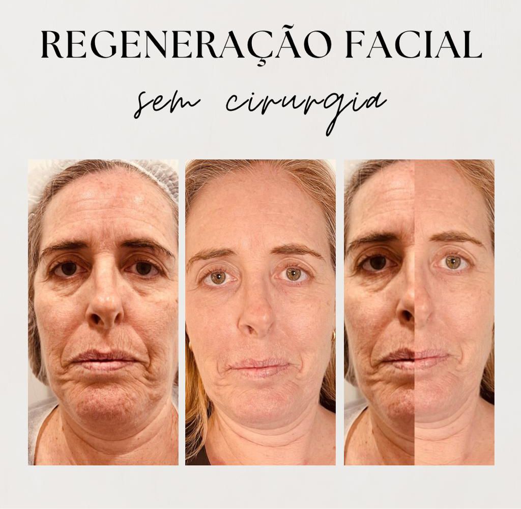 Procedimento Regeneração Facial Dra. Isabela Corsini de Campinas 