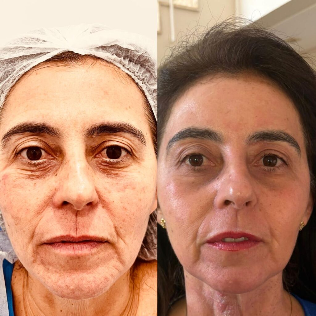 Procedimento da Médica Oftalmologista Dra. Isabela Corsini de Campinas